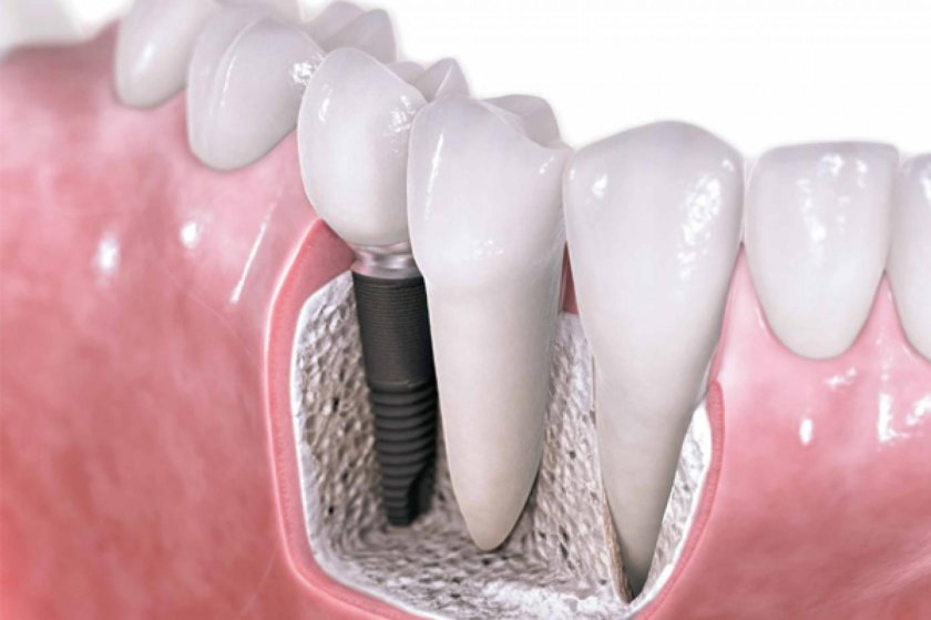 Имплантация зубов под ключ