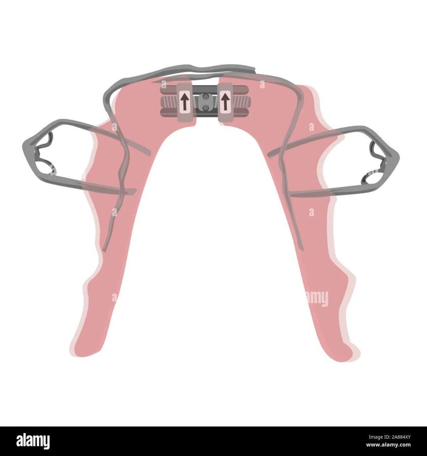 Расширитель челюсти ортодонтический