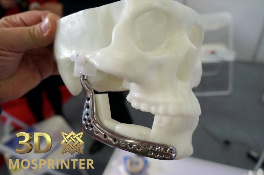 Импланты Медпор лицевые