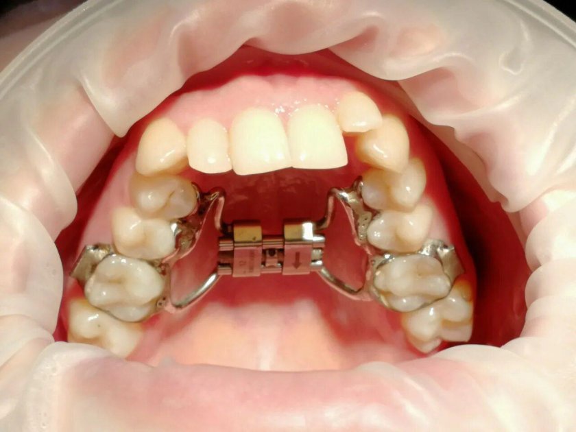 Несъемный аппарат Дерихсвайлера
