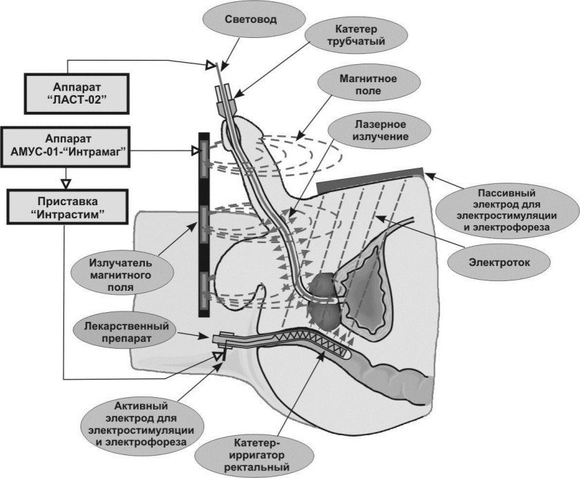 Прибор для электростимуляции простаты