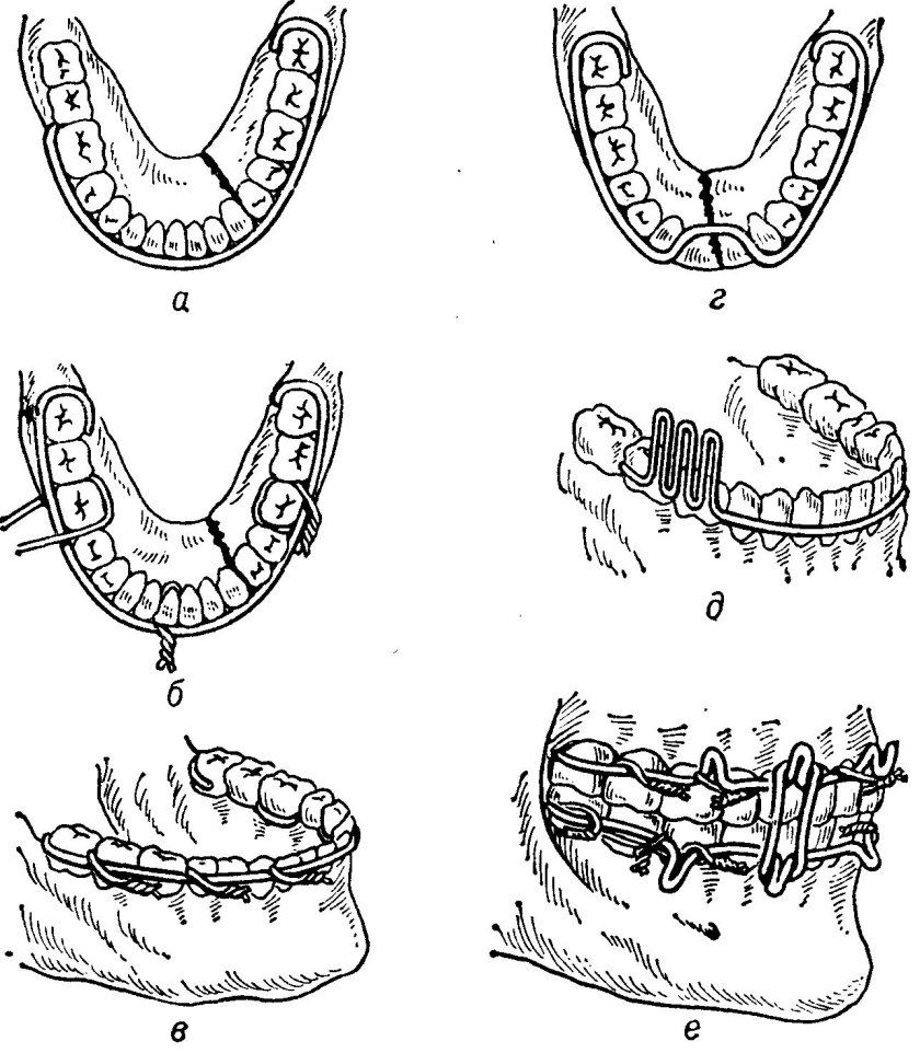 Шинирование при переломе нижней челюсти