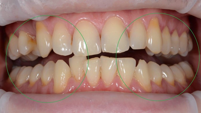 Закрытие рецессии десны