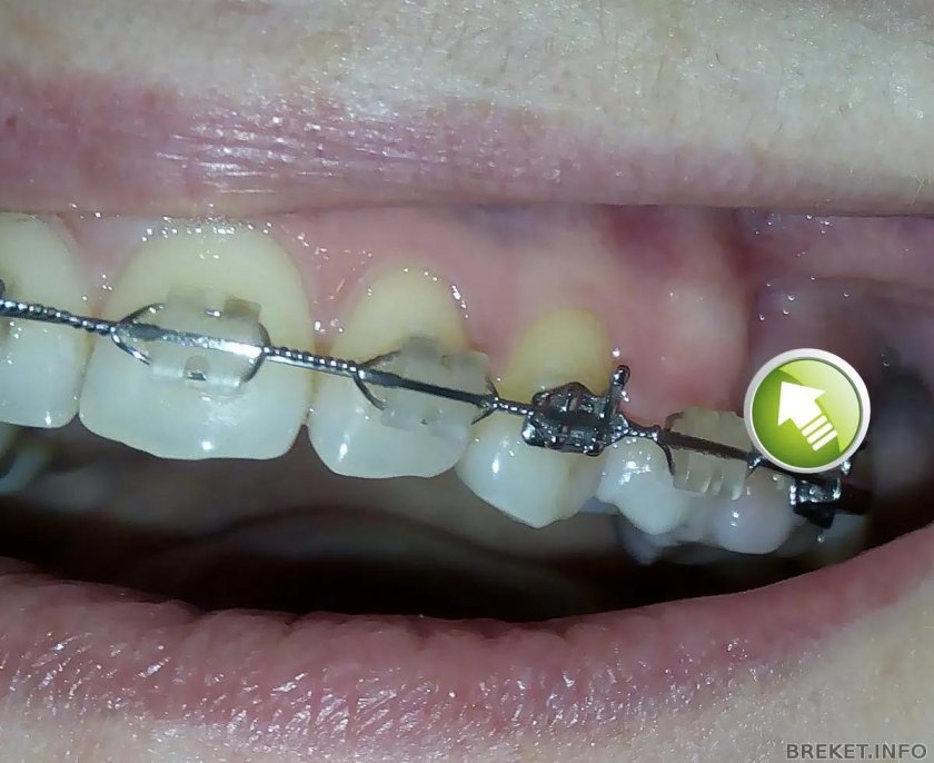Дуга на брекетах