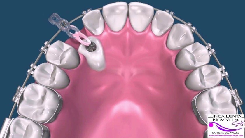 Ретинированный клык брекеты