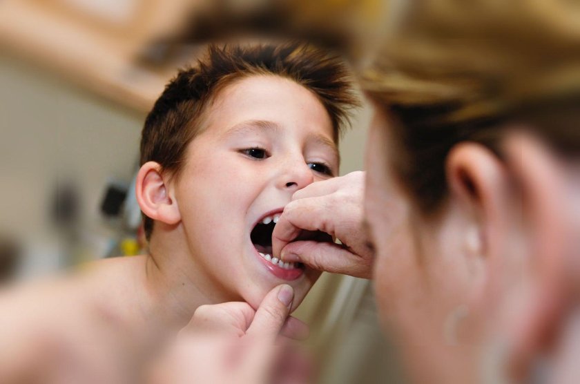 Вырывание молочного зуба