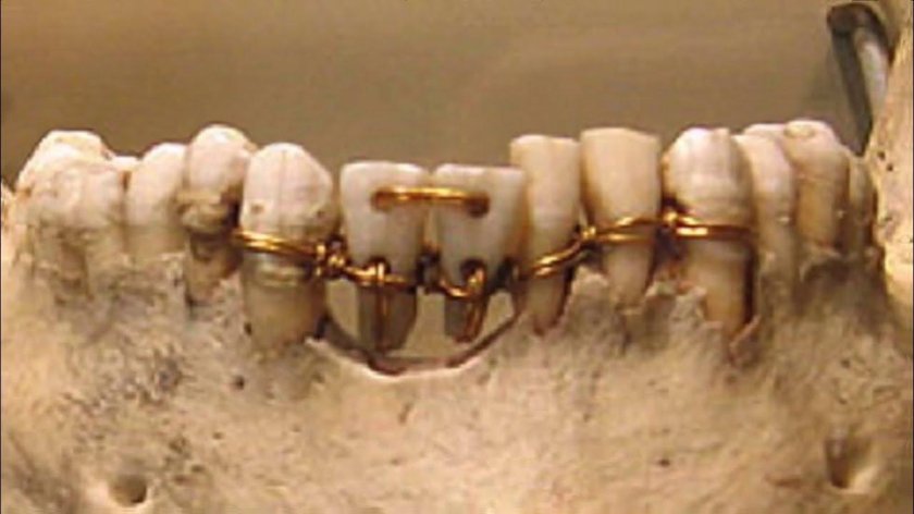 Зубные протезы в древнем Египте