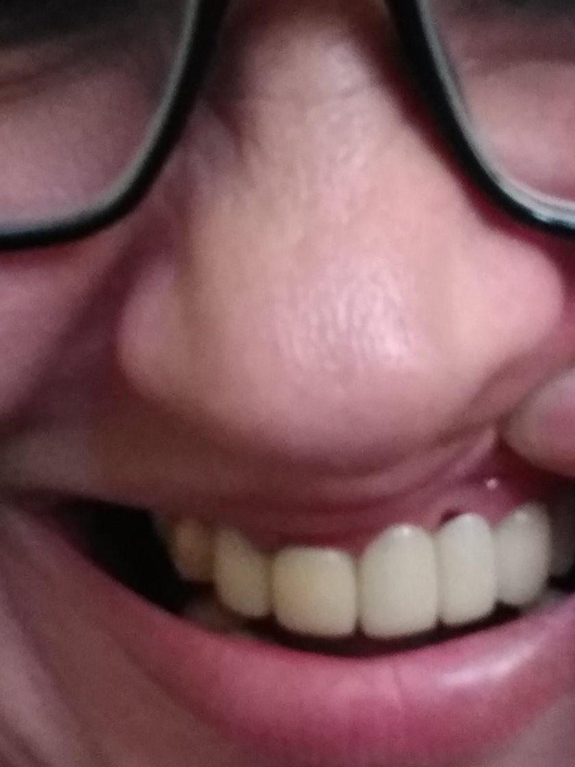 Щель между коронкой и Десной