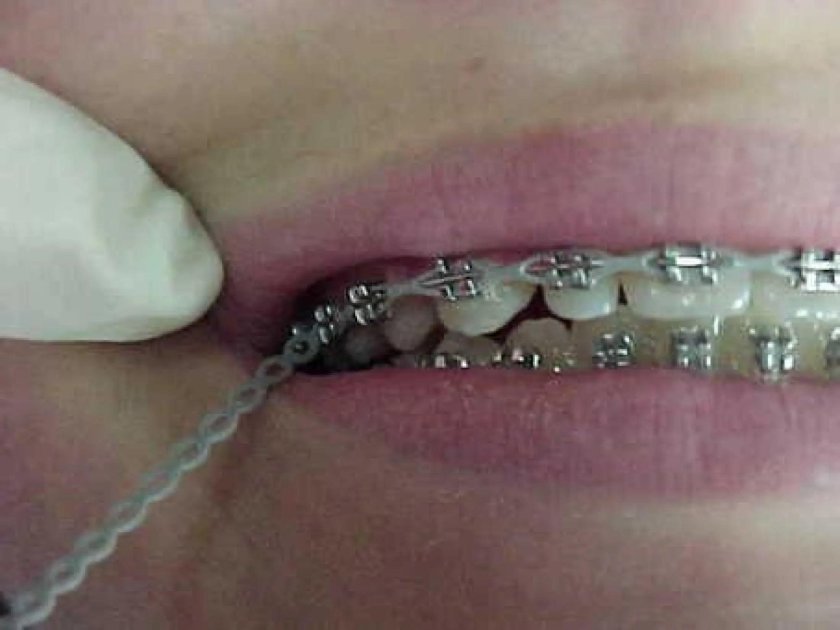 Проволочные лигатуры брекеты