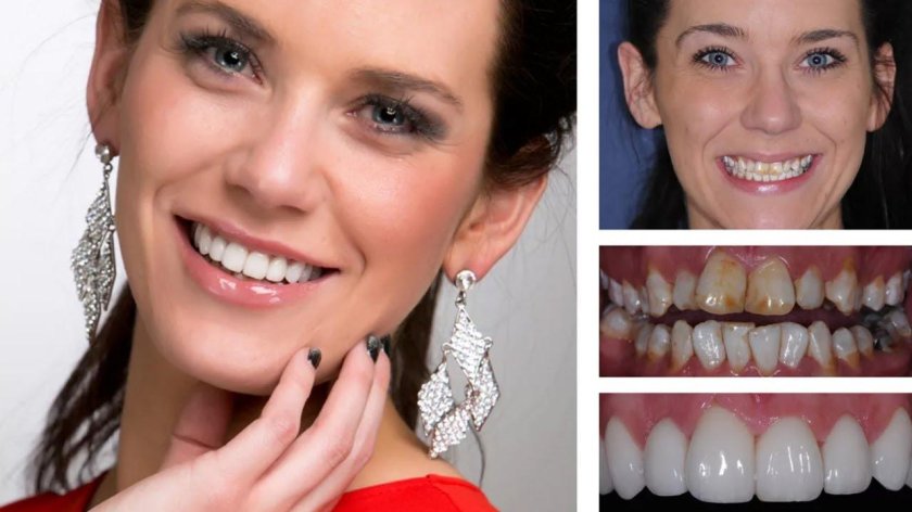 Фотокомпозитные виниры