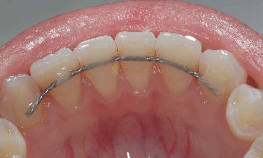 Шинирование зубов лигатурой