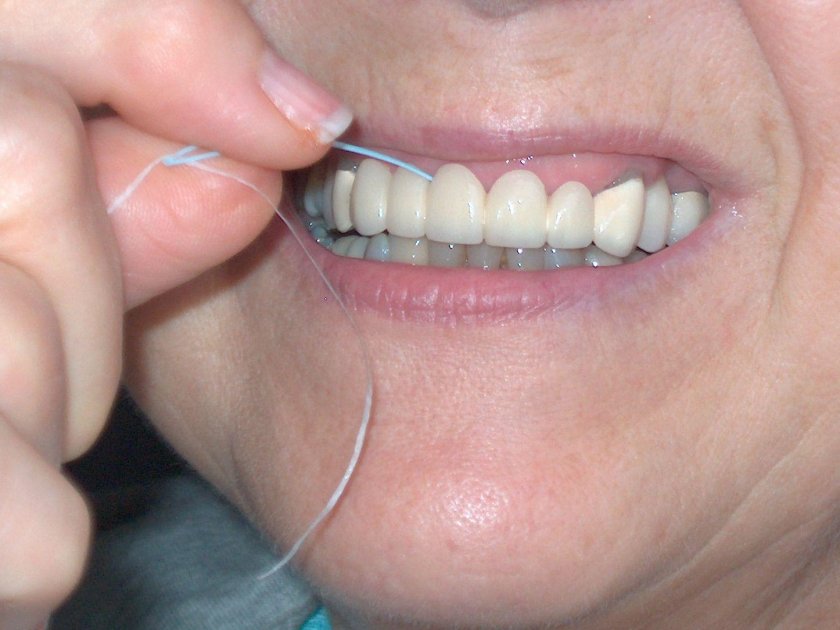 Металлокерамический мост