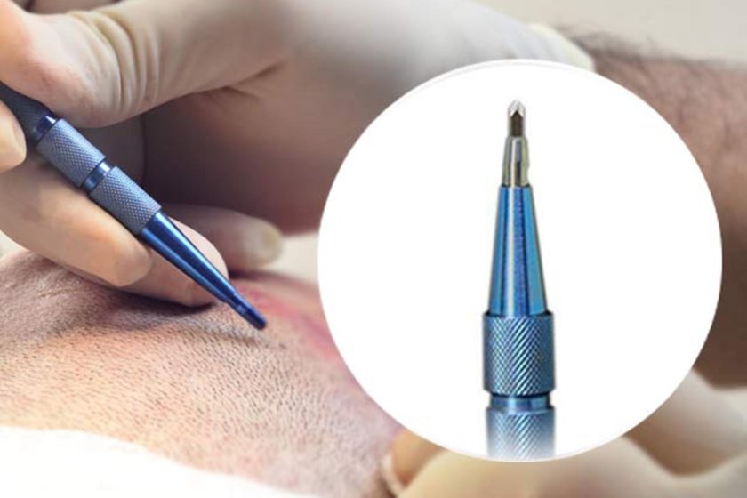 Sapphire hair transplant Sapphire hair transplant