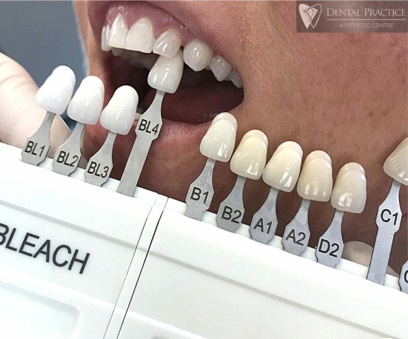 Виниры по шкале Вита 1м1