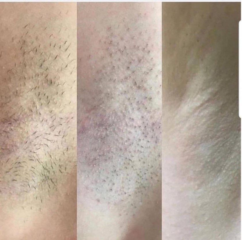 Лазерная эпиляция